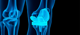 Dr Akhilesh Yadav Total Knee Replacement